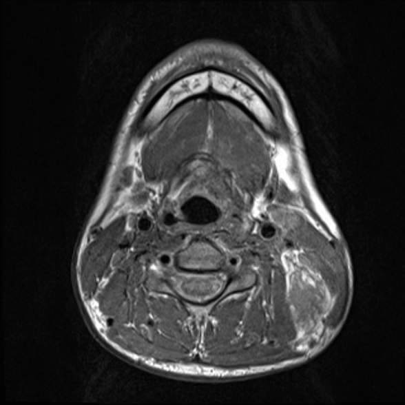 Nasopharyngeal carcinoma with skull base invasion (Radiopaedia 53415-59485 Axial T1 51).jpg