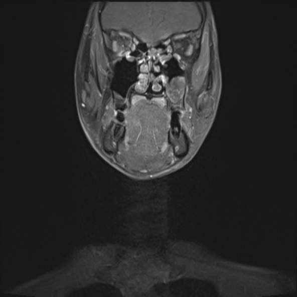 Nasopharyngeal carcinoma with skull base invasion (Radiopaedia 53415-59485 E 31).jpg