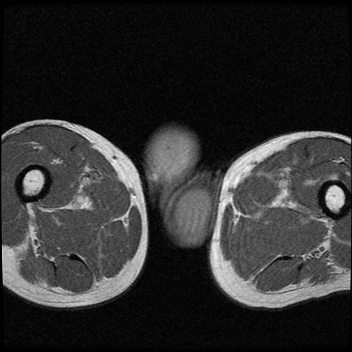File:Necrotizing epididymo-orchitis with intra-testicular abscess (Radiopaedia 29397-29860 Axial T1 C+ 17).jpg