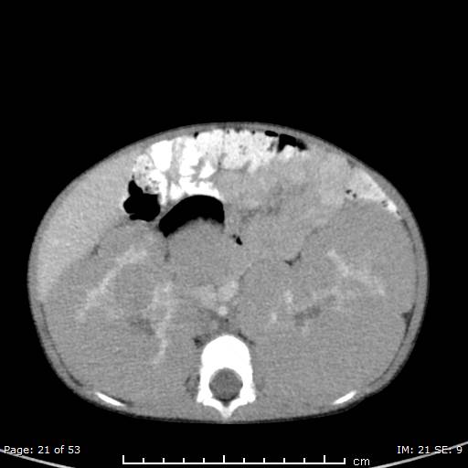 Nephroblastomatosis (Radiopaedia 41934-44935 A 21).jpg