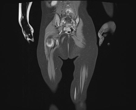 File:Neuroblastoma with bone metastases (Radiopaedia 67080-76414 E 21).jpg