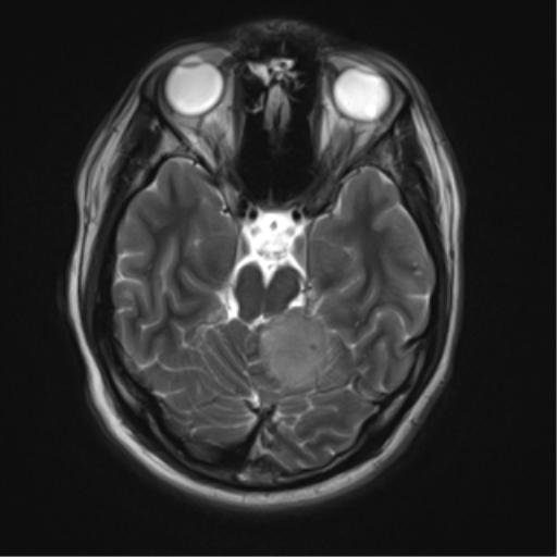 File:Neurofibromatosis type 2 (Radiopaedia 44936-48838 Axial T2 8).png