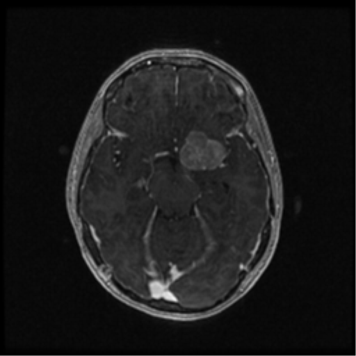 Neurofibromatosis type 2 (Radiopaedia 45229-49244 Axial T1 C+ 54).png