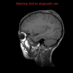 File:Neurofibromatosis type 2 (Radiopaedia 8953-9730 Sagittal T1 5).jpg