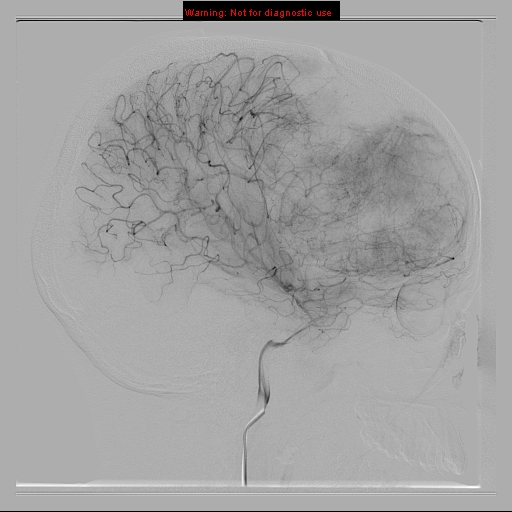 File:Neurofibromatosis type 2 (Radiopaedia 8953-9733 C 10).jpg