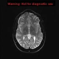 File:Neuroglial cyst (Radiopaedia 10713-11184 Axial DWI 12).jpg