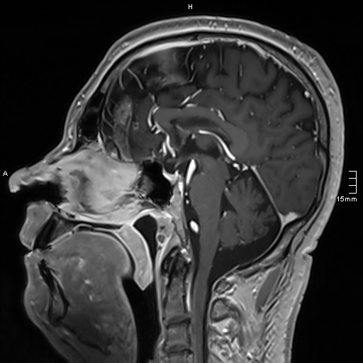 Neurosarcoidosis - involvement of the mesial temporal lobes (Radiopaedia 67429-76820 Sagittal T1 C+ 84).jpg
