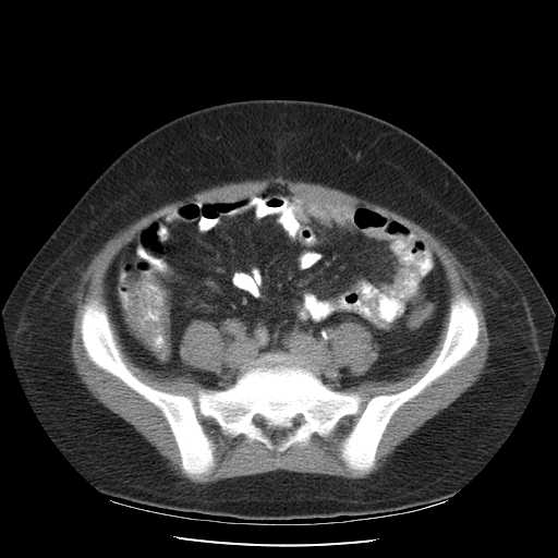 File:Non-Hodgkin lymphoma involving pelvis (Radiopaedia 21281-21197 B 45).jpg