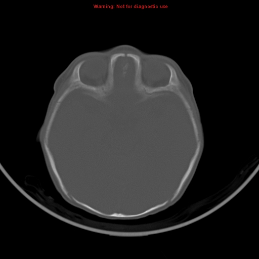 File:Non-accidental injury - bilateral subdural with acute blood (Radiopaedia 10236-10765 Axial bone window 9).jpg