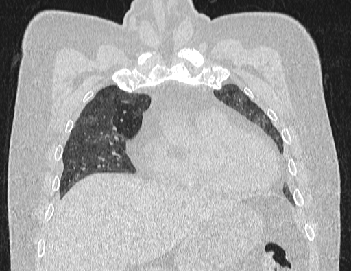Non specific interstitial pneumonia (NSIP) (Radiopaedia 89725-106798 Coronal lung window 23).jpg