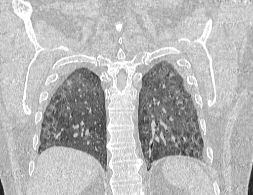Non specific interstitial pneumonia (NSIP) (Radiopaedia 89725-106798 Coronal lung window 59).jpg