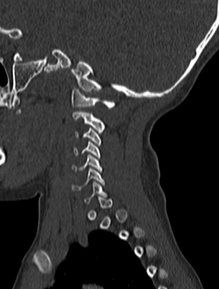 File:Normal CT cervical spine - pediatric (Radiopaedia 52549-58462 Sagittal bone window 172).jpg