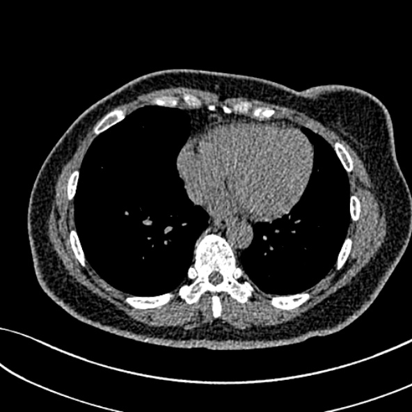 Normal CT chest- adult female (Radiopaedia 52522-58428 Axial non-contrast 88).jpg