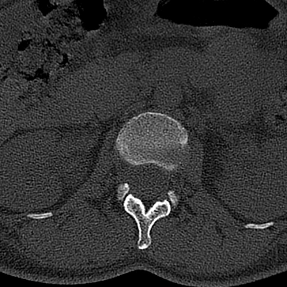File:Normal CT lumbar spine (Radiopaedia 53981-60118 Axial bone window 18).jpg