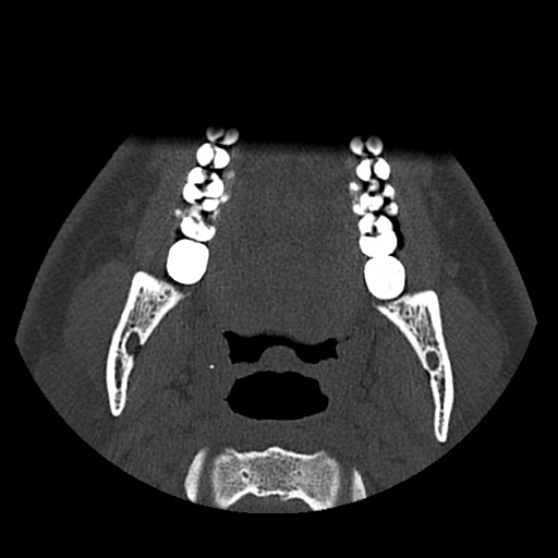 Normal CT paranasal sinuses (Radiopaedia 42286-45390 Axial bone window 116).jpg