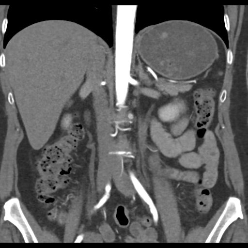 File:Normal CT renal artery angiogram (Radiopaedia 38727-40889 B 42).png