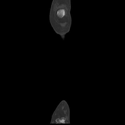 Normal CT tibia and fibula (Radiopaedia 51195-56848 Coronal non-contrast 17).jpg