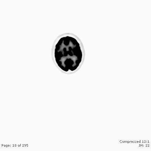 File:Normal F-18 FDG PET-CT (Radiopaedia 77382-89510 C 18).jpg