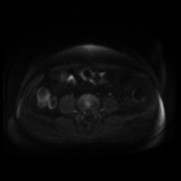 Normal MRI abdomen in pregnancy (Radiopaedia 88005-104548 Axial DWI 107).jpg