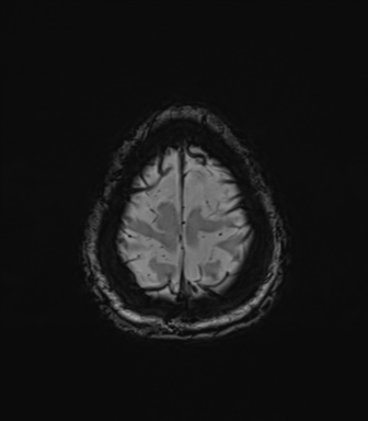 Normal brain MRI (TLE protocol) (Radiopaedia 40748-43405 Axial SWI 81).png
