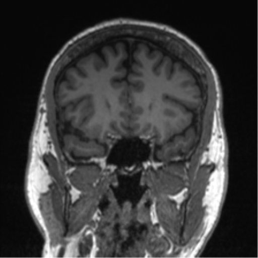 Normal brain MRI (non-focal epilepsy protocol) (Radiopaedia 53917-60040 Coronal T1 47).png