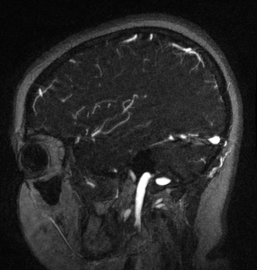 Normal brain MRI and venogram (Radiopaedia 39554-41862 Sagittal MRV 50).jpg