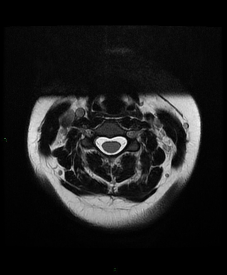 Normal cervical spine MRI (Radiopaedia 80146-93454 Axial T2 33).jpg