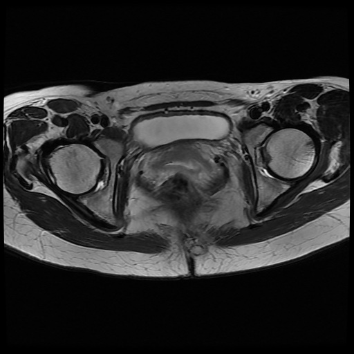File:Normal female pelvis MRI (retroverted uterus) (Radiopaedia 61832-69933 Axial T2 22).jpg