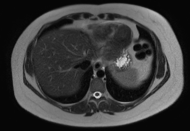 File:Normal liver MRI with Gadolinium (Radiopaedia 58913-66163 Axial T2 28).jpg