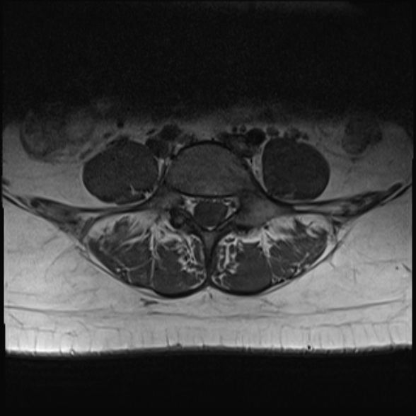 File:Normal lumbar spine MRI- 3 T (Radiopaedia 53280-59250 Axial 23).jpg
