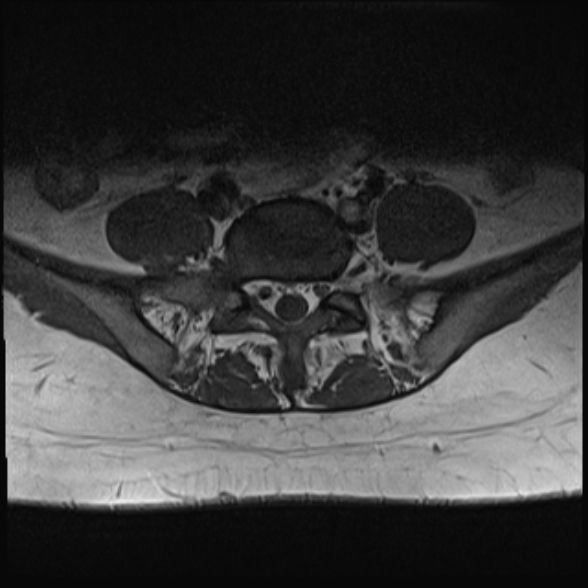 File:Normal lumbar spine MRI- 3 T (Radiopaedia 53280-59250 Axial 28).jpg