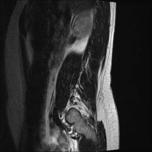 File:Normal lumbar spine MRI- 3 T (Radiopaedia 53280-59250 Sagittal T2 3).jpg