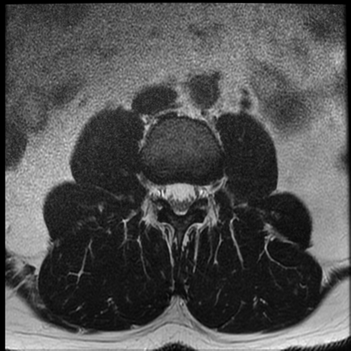 File:Normal lumbar spine MRI (Radiopaedia 35543-37039 Axial T2 27).png