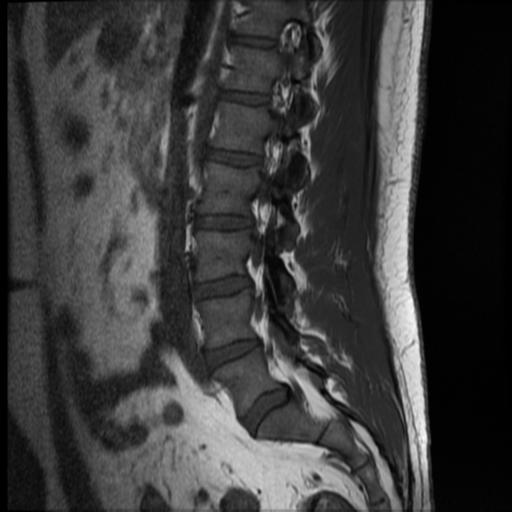 File:Normal lumbar spine MRI (Radiopaedia 35543-37039 Sagittal T1 9).png