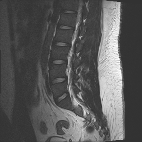 File:Normal lumbar spine MRI (Radiopaedia 47857-52609 Sagittal T2 13).jpg