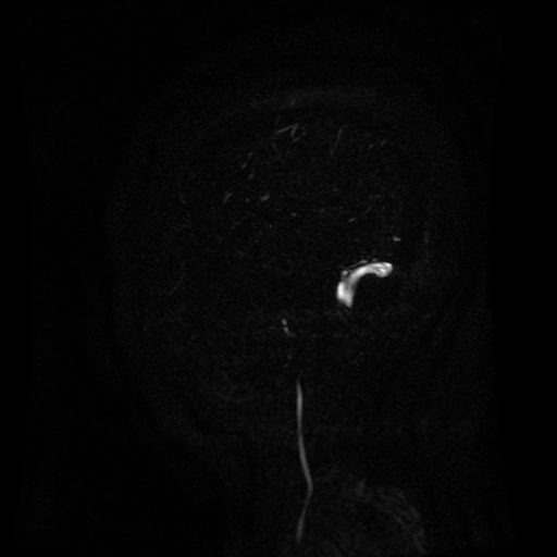 Normal noncontrast MR venography (Radiopaedia 87578-103957 A 152).jpg