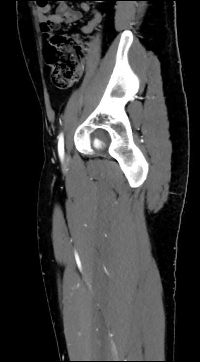 Normal pelvis CT angiogram (Radiopaedia 84966-100481 C 33).jpg