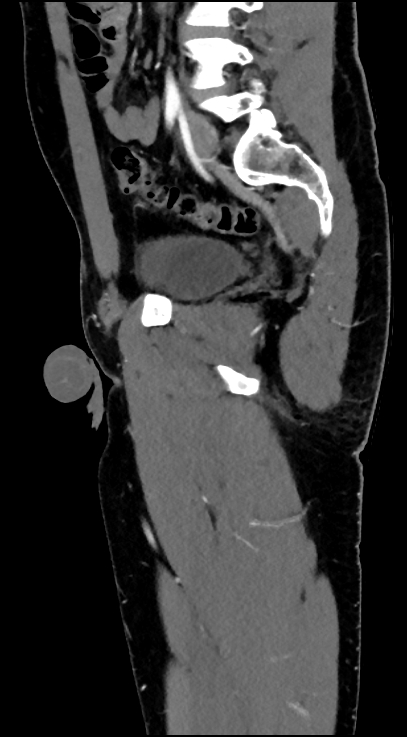 Normal pelvis CT angiogram (Radiopaedia 84966-100481 C 66).jpg
