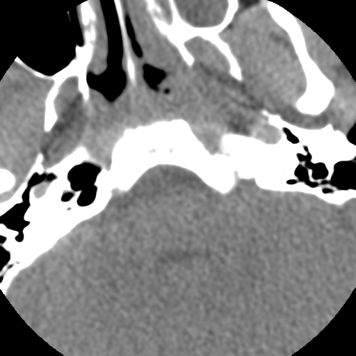Normal trauma cervical spine (Radiopaedia 41017-43760 Axial non-contrast 3).png