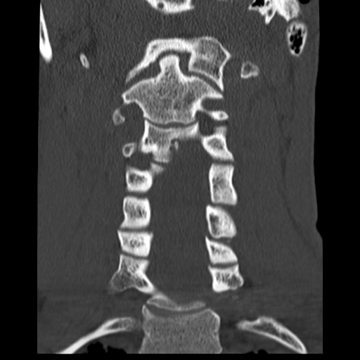 File:Normal trauma cervical spine (Radiopaedia 41017-43760 Coronal bone window 17).png