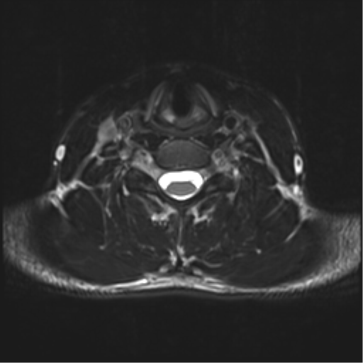 Normal trauma cervical spine (Radiopaedia 41017-43762 D 36).png