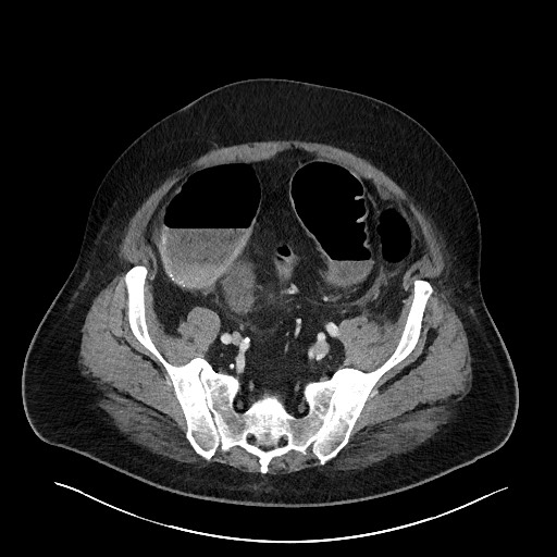 Obstructing sigmoid adenocarcinoma (Radiopaedia 58465-65619 A 126).jpg