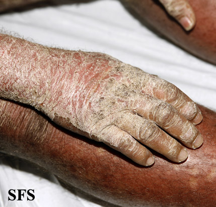 File:Psoriasis (Dermatology Atlas 62).jpg