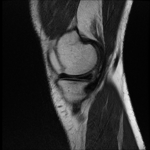 File:ACL acute full thickness tear - deep lateral femoral sulcus sign (Radiopaedia 38594-40740 Sagittal T2 3).jpg