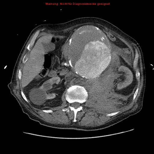 File:Abdominal aortic aneurysm- extremely large, ruptured (Radiopaedia 19882-19921 Axial C+ arterial phase 26).jpg