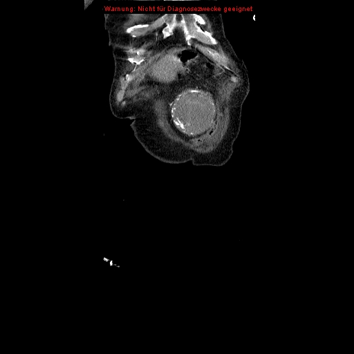 Abdominal aortic aneurysm- extremely large, ruptured (Radiopaedia 19882-19921 Coronal C+ arterial phase 9).jpg