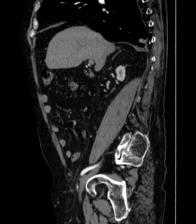 Abdominal aortic aneurysm (Radiopaedia 25855-26001 Sagittal C+ arterial phase 4).jpg