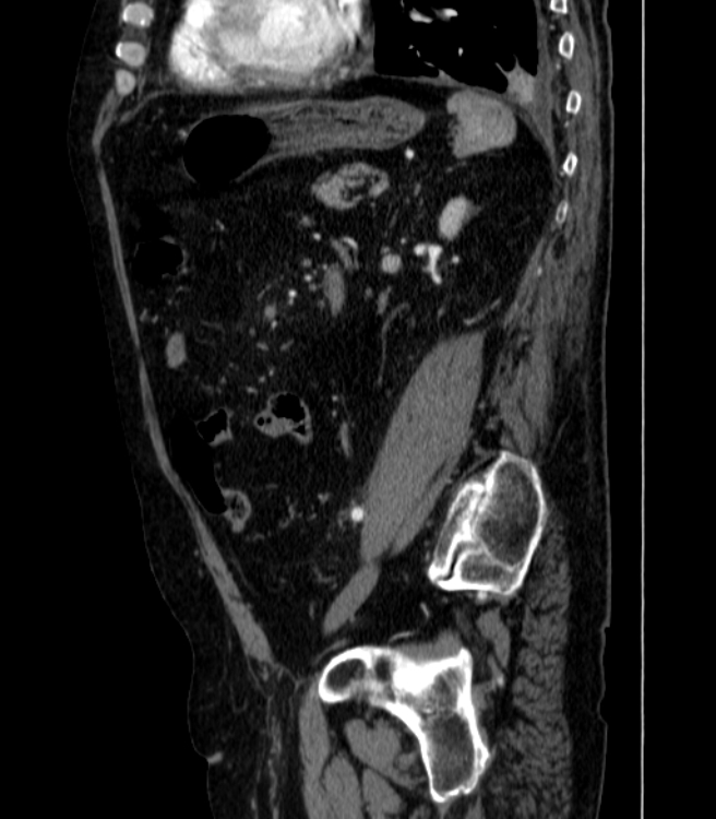 Abdominal aortic aneurysm (Radiopaedia 25855-26001 Sagittal C+ arterial phase 47).jpg