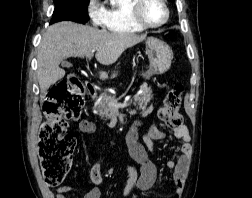 File:Abdominal aortic aneurysm (Radiopaedia 67117-76452 Coronal C+ arterial phase 17).jpg