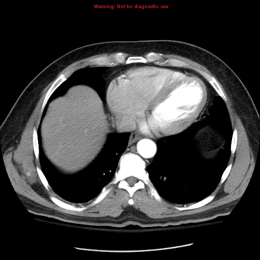 Abdominal aortic aneurysm (Radiopaedia 8190-9038 Axial C+ arterial phase 5).jpg